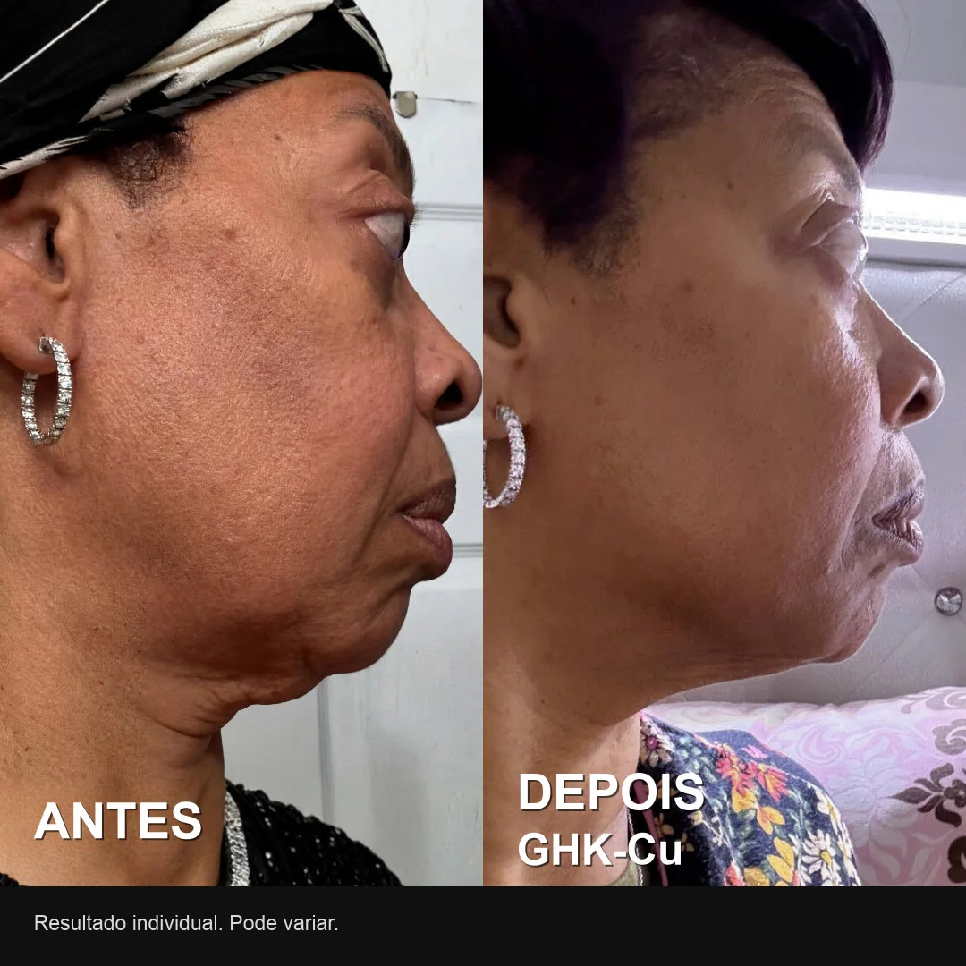 Antes e depois real de usuária do PDRN: contorno de perfil mais firme