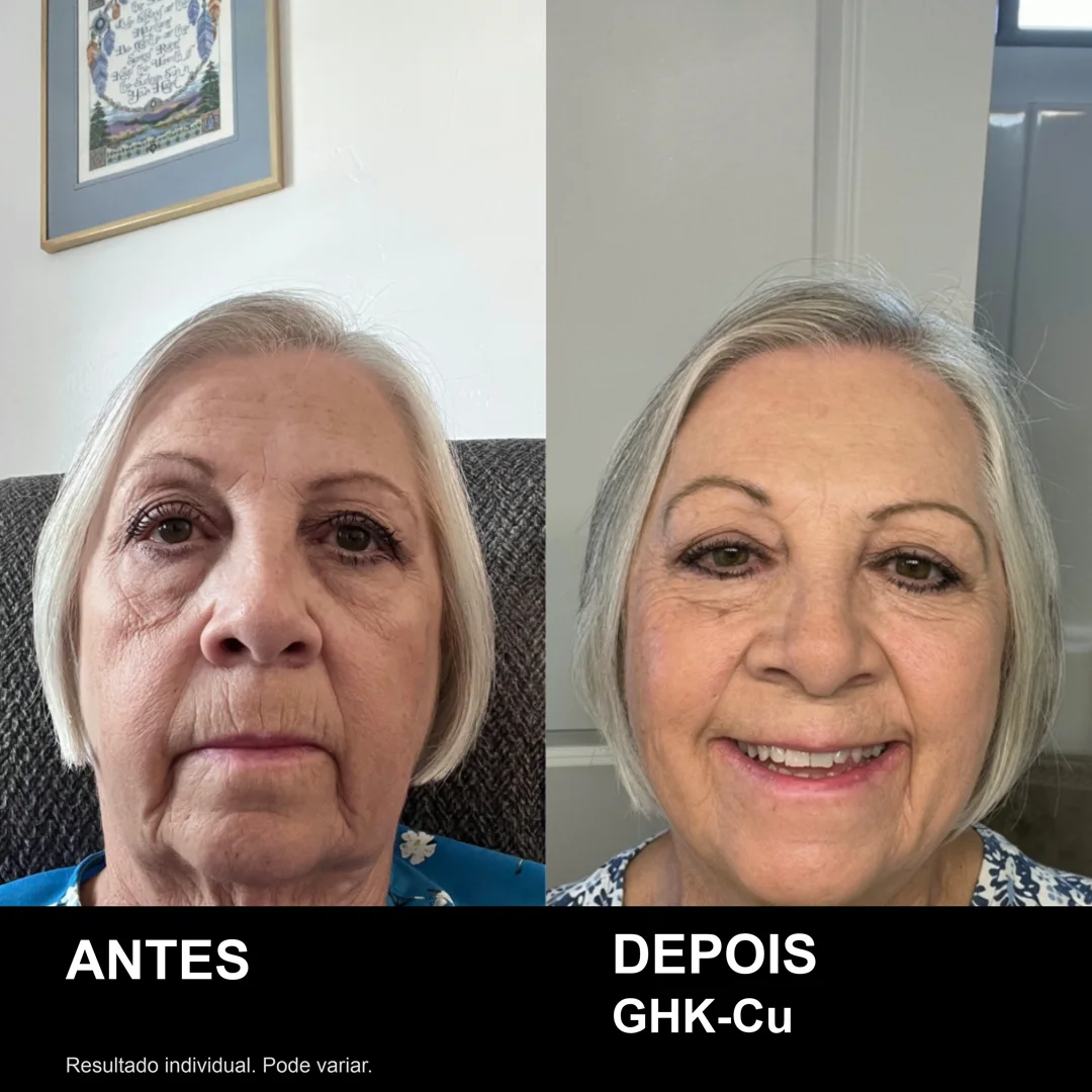 Antes e depois real de usuária do PDRN: rosto mais firme e uniforme