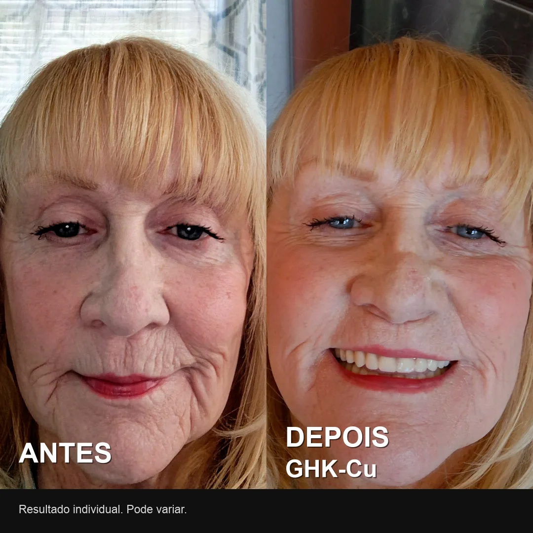 Antes e depois real de usuária do PDRN: menos linhas ao redor da boca